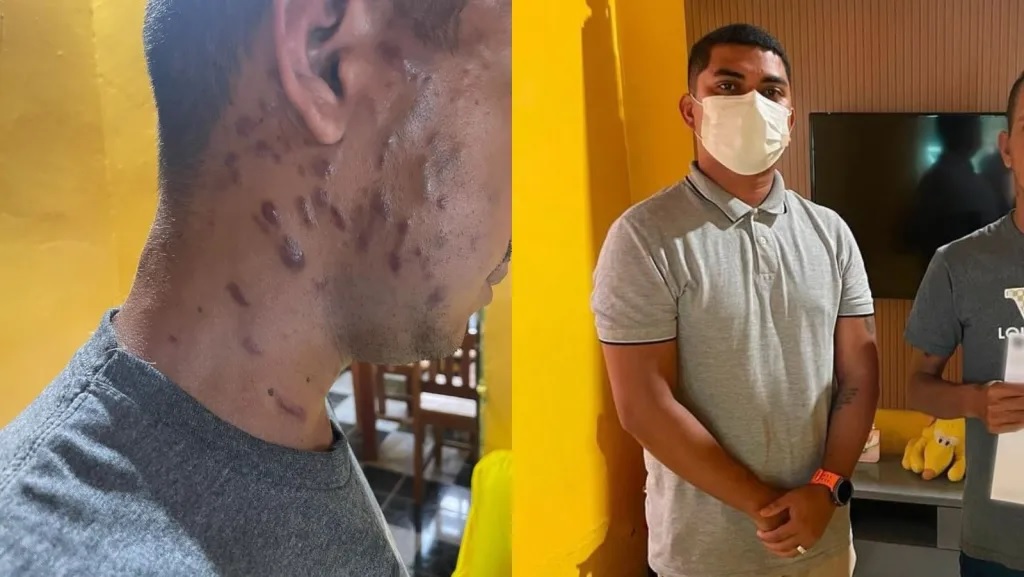 Secretaria de Saúde de Moju descarta caso suspeito de Mpox